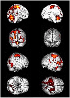 Driving Ability in Alzheimer Disease Spectrum: Neural Basis, Assessment, and Potential Use of Optic Flow Event-Related Potentials